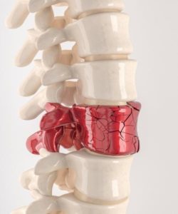 fracturas en la columna vertebral