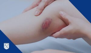 Tipos de lesiones en las piernas tras un accidente de tránsito